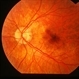 Myopic CNV Myopic CNV